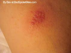 40 Insect Bites Ideas Insect Bites Bitten Fleas