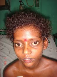 Back to your specific situation. Clinical Photograph Of The Patient Showing Woolly Curly Hair Download Scientific Diagram