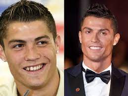 #cristiano ronaldo #cr7 #cristiano #juve #young cristiano ronaldo #ronaldo #young ronaldo #football #football star #football stars #cristianoronaldo #portugal #portugal team #vintage #vintage ronaldo #vintage cristiano ronaldo #football player #fifa #cristiano ronaldo dos santos aveiro. Cristiano Ronaldo Tom Cruise Emma Watson And 4 More Celebrities Who Wore Dental Braces To Fix Their Teeth South China Morning Post