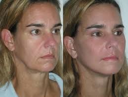 But what about sagging jowls? How To Get Rid Of Jowls Arxiusarquitectura