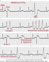 Pin By Ayka Sh Va On Medizin Nurse Icu Nursing Ekg