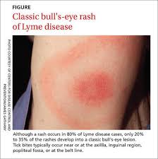 Ticks can spread other organisms that may cause a different type of rash. Beyond The Bull S Eye Recognizing Lyme Disease Clinician Reviews