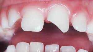 At that time, the inner pulp of the tooth may be exposed while the tooth's blood vessels and connective tissues so, if you are suffering from a toothache and want to know how to reduce the pain and swelling around your affected tooth before visiting a dentist, you. Fractured Permanent Front Teeth Kid Focus Dentistry