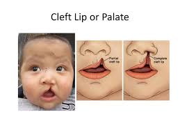 Cleft Lip or Palate.
