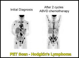 Pet scans, short for positron emission tomography, can detect areas of cancer by obtaining images of the body's cells as they work. Pet Imaging In Hematology Ask Hematologist Understand Hematology