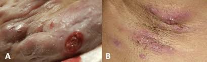 Image result for Skin Abscess