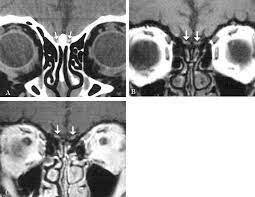 Calcification Of The Olfactory Bulbs In Three Patients With Hyposmia American Journal Of Neuroradiology