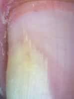 Fungo em si não causa dor, mas o fungo pode causar deformidade da unha podendo causar dor, procure um médico dermatologista para tratar. Micose De Unha Sinais E Tipos De Onicomicose Orientacao Medica Essencial