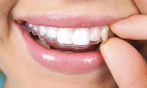 Complete Invisalign Or Braces Package At Galleria Dental Center Up To 98 Off Teeth Straightening Dental Braces Invisalign