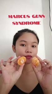 Marcus Gunn Story Pictures