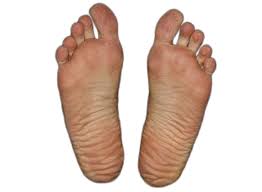 Image result for diabetic toes
