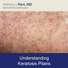 Image result for Keratosis pilaris