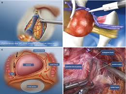 Image result for Radical Prostatectomy