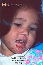 Image result for scabies human children