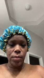 charettecosmetics MelanX Level 2 Chemical Peel. Day 2. #skincare #se...