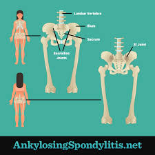 Pin On Ankylosing Spondylitis