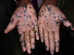 Touched By The Leper Stitchingupbangladesh