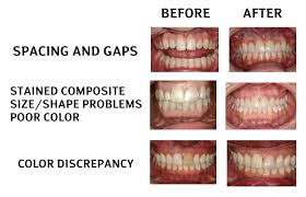 385 likes · 11 talking about this. Can I Improve My Smile With Veneers Krusich Dental Leawood Ks
