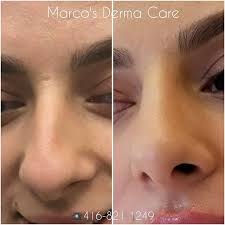 Non Surgical Nose Correction 416 821 1249 Https Marcosdermacare Com Nonsurgicalnosejob Beforeandafter Nonsurgical Nose Job Nose Reshaping Rhinoplasty