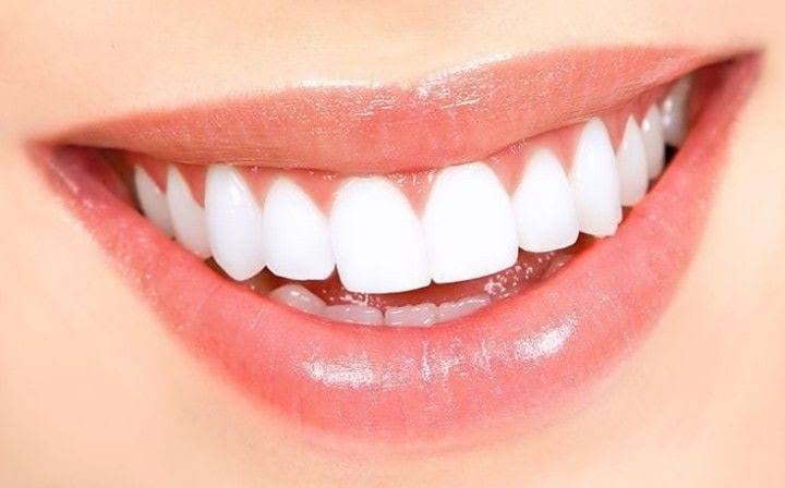 Veneers product image