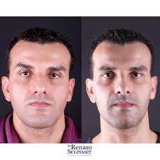 Cirurgia Ortognática. Procedimentos realizados: -Avanço maxilar com  segmentação; -Osteoplastia da mandíbula; -Mentoplastia; Equipe: Renato  Schröder Taíse Simonetti @taisesimonetti Fabrício Rocha  @fabriciorochagoncalves Bruno Trevisan @drbrunotrevisan ...