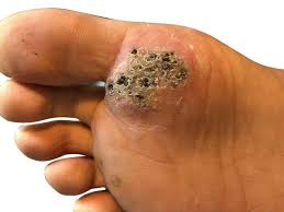 In contrast with planter warts, other warts develop on the fingers, toes or hands, are usually more elevated. Seed Wart Causes Symptoms Treatment Methods For Removal