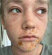 What helps severe eczema with hashimotos?