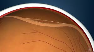 In most cases vision can be restored completely if the retinal detachment has not advanced to the macula. Retina Louisville Retinal Detachment Louisville Bennett Bloom