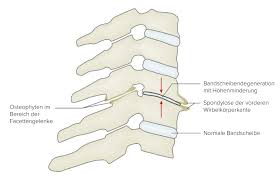 Spondylose Deximed