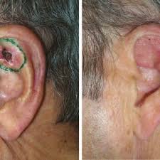 Skin cancer is one of the most common types of cancer. Subcutaneous Pedicle Posterior Auricular Revolving Door Flap Left Download Scientific Diagram