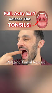 👂 Feeling that deep, full, or achy pressure in your ear, like it just  won’t “pop”? Sometimes, the tension and fluid buildup start deeper than the  ear, around the palatine tonsils, which sit just ...