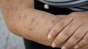 Image result for skin rash similar to scabies