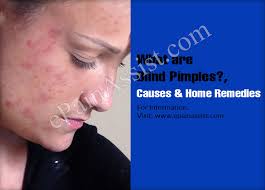 Pimples under the skin are usually called blind pimples and they cause pain because they occur deep under this skin close to nerves. Blind Pimples Causes And Home Remedies