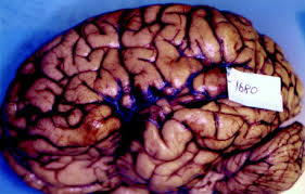 Image result for Brain Contusion