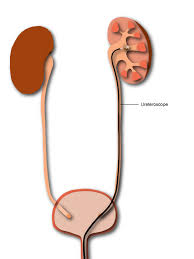 Ureteroscopy For Kidney Stones Laser Lithotripsy Kidneystoners Org