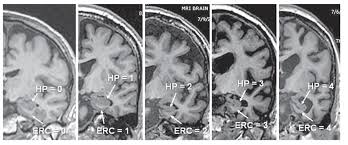 It's rare in people under 65. Role Of Mri In Diagnosis Of Mild Cognitive Impairment And Alzheimer S Disease Brain Stories