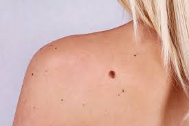 This collection of photographs will help you tell the difference between normal moles (nevi, nevus) and melanoma skin cancer. Best Mole Removal Los Angeles Santa Monica Dr Tanya Kormeili Dermatology