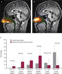 Breath Powered Sumatriptan Dry Nasal Powder An Intranasal Medication Delivery System For Acute Treatment Of Migraine Abstract Europe Pmc