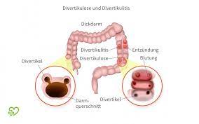 Divertikel Im Darm Divertikulose Divertikulitis Symptome Ernahrung Behandlung Onmeda De