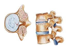 The spinal canal lies within the spine and encases the spinal cord. Spinal Stenosis Overview And More