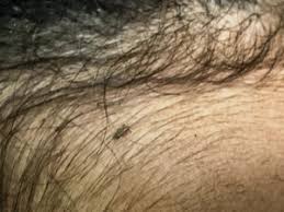 Make note of certain characteristics of the pest, including shape, size, color, number of legs, and whether or not it has wings and/or antennae. Black Lice And Lice In Black Hair With Pictures My Lice Advice