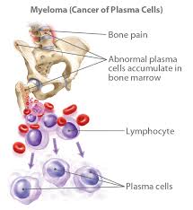 They can develop anywhere in the body.) there are many kinds of primary bone cancer. Learn About Leukemia Information Facts Overview Ctca