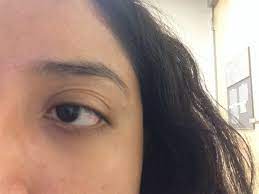 We did not find results for: Is It Possible To Remove An Extra Eyelid Crease Photo