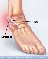 Grand Avenue Surgical Center Sprained Ankle Sprain Foot Drop Exercises