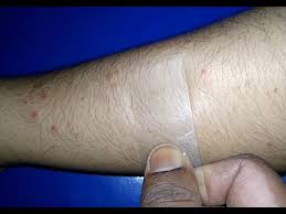 Image result for Diascopy