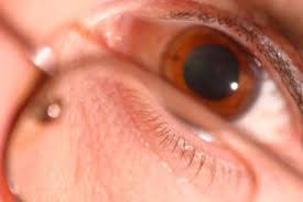 Image result for Mydriasis