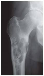 Image result for Chondrosarcoma