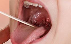 Throat cancer the term head and neck cancer refers to a group of biologically similar cancers originating from the upper aerodigestive tract, including the album was released by atlantic records on june 8, 2010. Mouth And Throat Cancer Feels Like Family Dentistry Elgin Sc