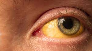 Ojos Amarillos Causas Y Tratamientos