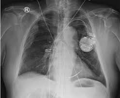 What does icd stand for? Answer To Quiz On Page 26 And Case Discussion The Icd Patient With Chest Pain